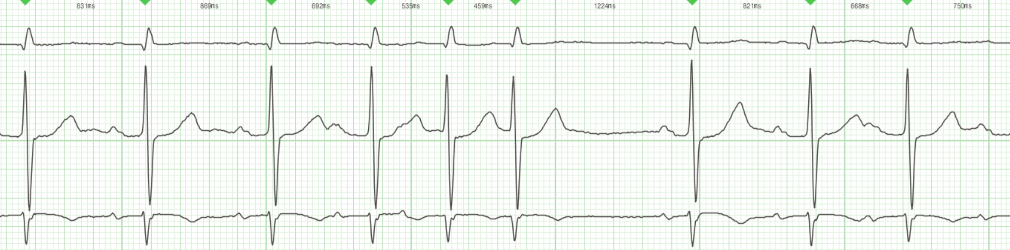 BAV grd I triplet SV faors 3c