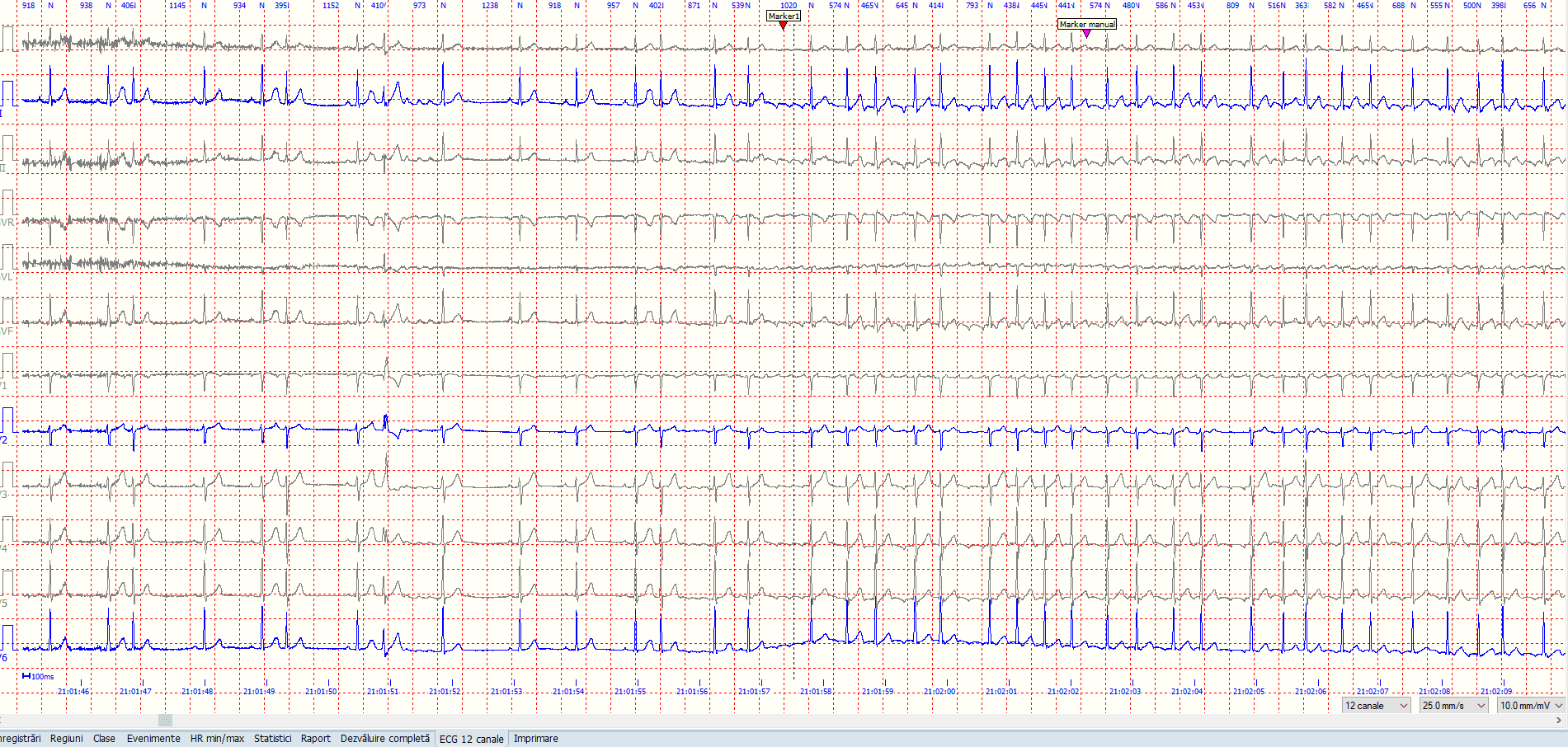 flutter atrial la debut
