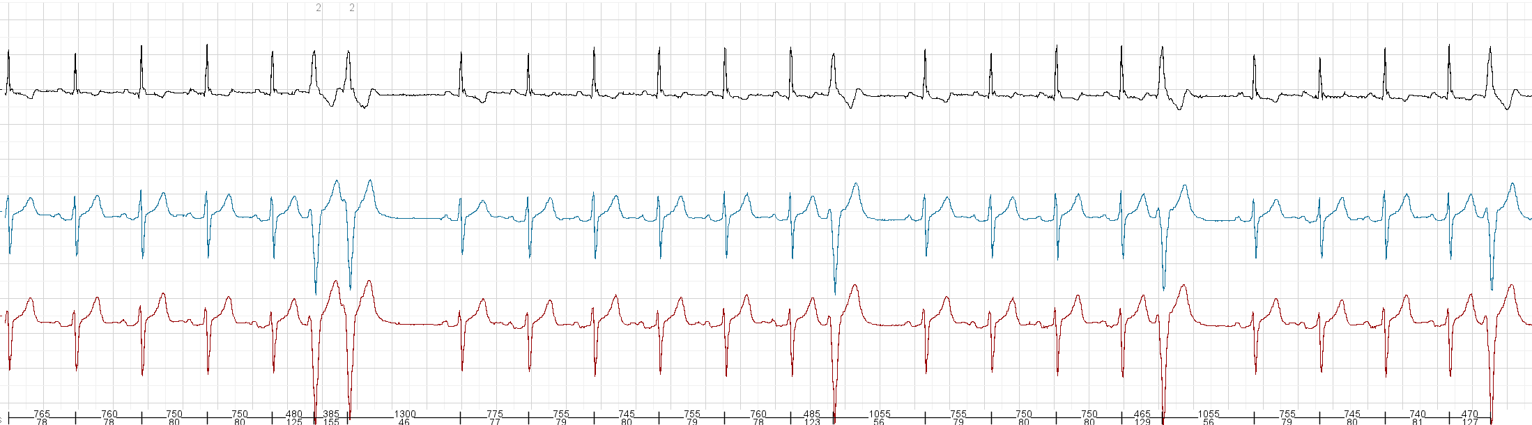 dublet ventricular